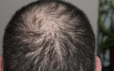 Best Baldness Treatment and Hair loss Treatment Santa Monica California
